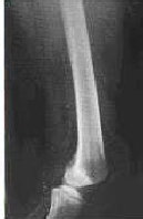 Posicionamiento Lateral de Fémur